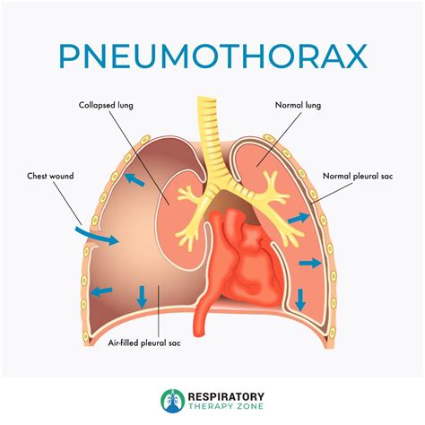 Pneumothorax: How to prevent it | Respiratory Therapy Zone posted on ...