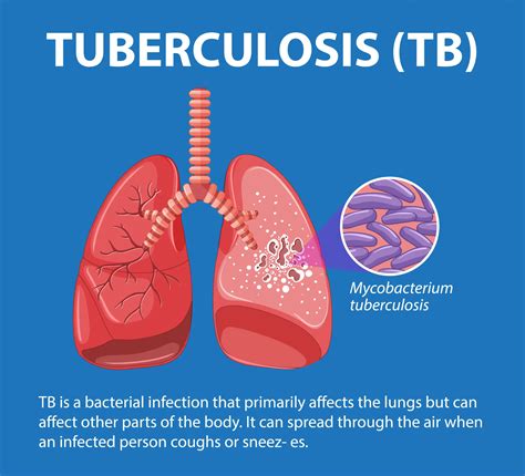 Tuberculosis Outbreak 2025: Symptoms, Vaccines, and Trends