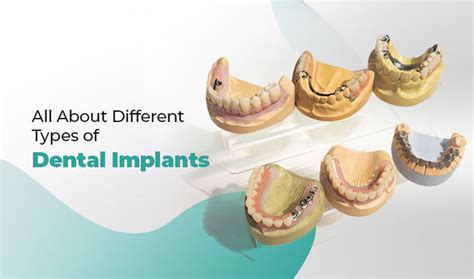 Image result for Different Types of Teeth Implants