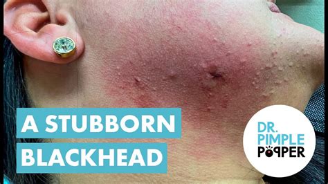 Image result for Large Pimples Exploding