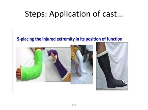 Principles of splints and casts in orthopaedics by Dr. D. P. Swami | PPTX