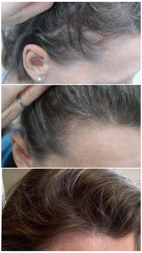 Peri-Post Menopausal Hair Loss Help - The Hair Clinic
