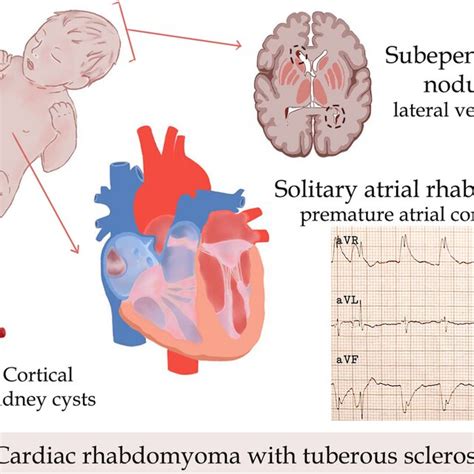 Atrial Fibrillation 的图像结果