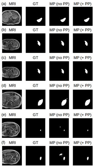 A Deep-Learning Approach to Spleen Volume Estimation in Patients with ...