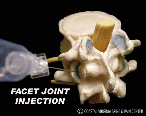 FACET JOINT INJECTION - Coastal Virginia Spine & Pain Center
