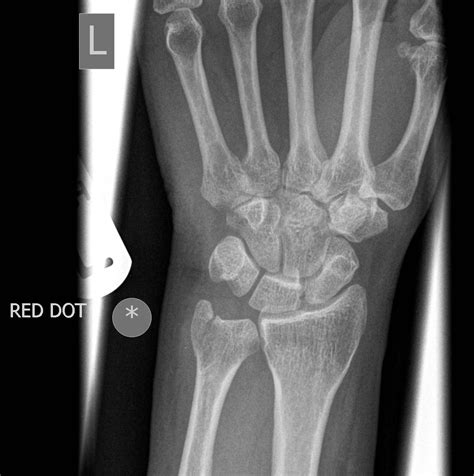 Wrist X Ray Abnormality at Marilyn Munford blog