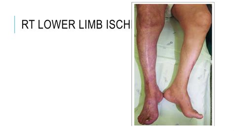 Acute Limb ischemia | PPTX