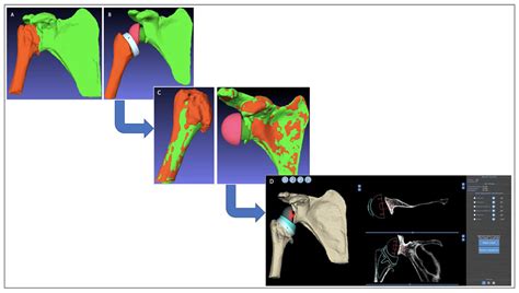 The Real Post-Operative Range of Motion Differs from the Virtual Pre ...