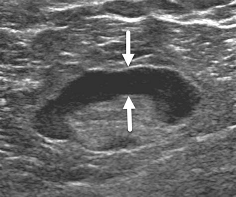 What Does Tumor Look Like On Ultrasound at Betty Dean blog