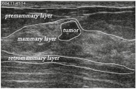 ESTAN: Enhanced Small Tumor-Aware Network for Breast Ultrasound Image Segmentation