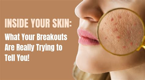 Inside Your Skin: What Your Breakouts Are Really Trying to Tell You ...