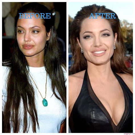 Celebrities Who Removed Their Breast Implants Beforeand
