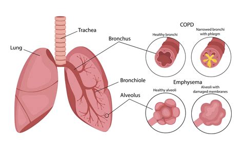 Barrel Chest Copd Emphysema