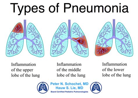 Dr Schochet Types of Pneumonia - Pediatric Pulmonologists