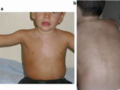 Image result for Pigment Mosaicism