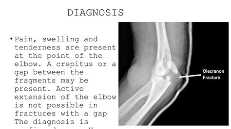 injuries around elbow joint orthopaedics ppt | PPTX