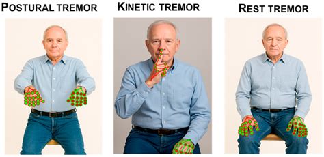 AI Video Analysis in Parkinson’s Disease: A Systematic Review of the ...