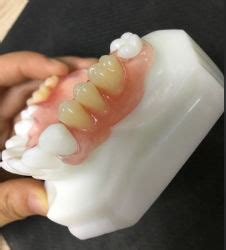 Valplast Prótesis de China, lista de productos de Valplast Prótesis de ...