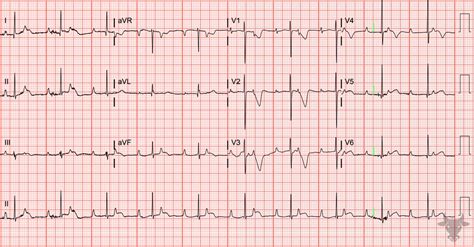 Third Degree Atrioventricular Block | ECG Stampede