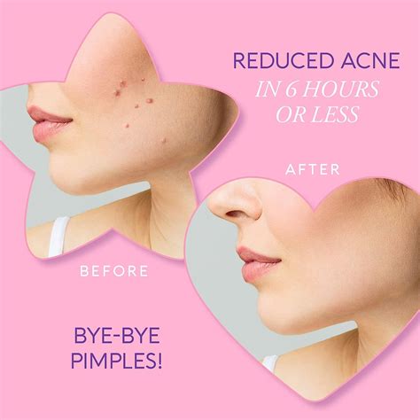 Buy Maree Acne Patches with Natural Green Algae Extract & Tea Tree Oil ...