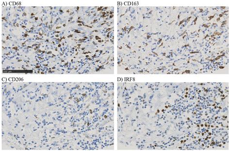 Association of CD206 Protein Expression with Immune Infiltration and ...