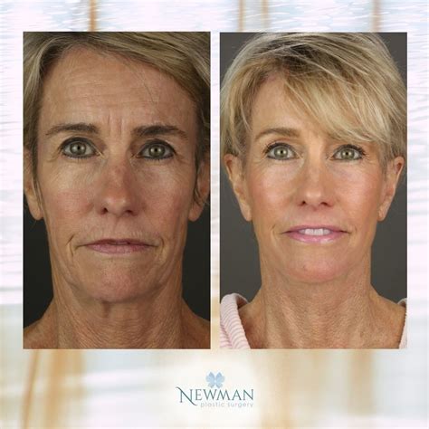Deep Plane Facelift | Temecula Plastic Surgery