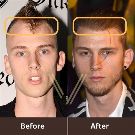 MGK's Hair Transplant: Before and After Transformation