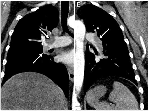Pulmonary Embolism - Causes, Signs & Symptoms, Diagnosis, Treatment