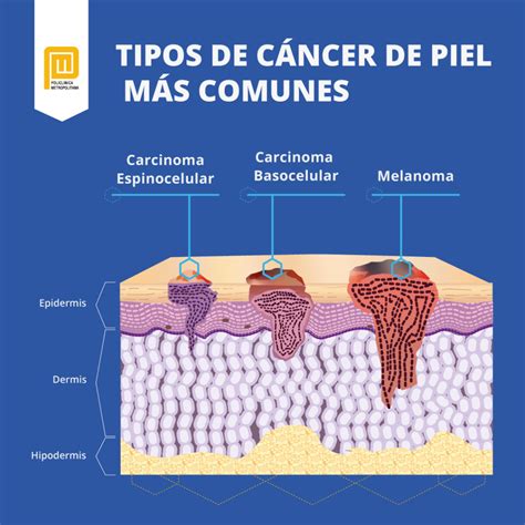 ¿Qué es el cáncer de piel y cómo se produce? – Policlinica Metropolitana