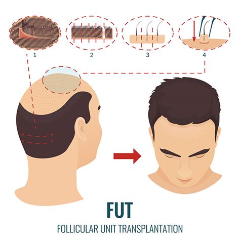 FUE vs. FUT: What Type of Hair Transplant is Best for you? | MedLinks
