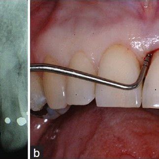 Image result for Two Walled Defect Perio