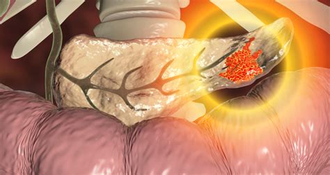 Survival rates for deadliest types of pancreatic cancer vary: Study