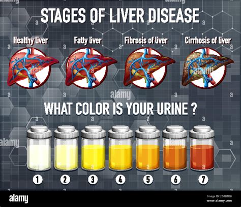 Stages of liver disease Stock Vector Image & Art - Alamy