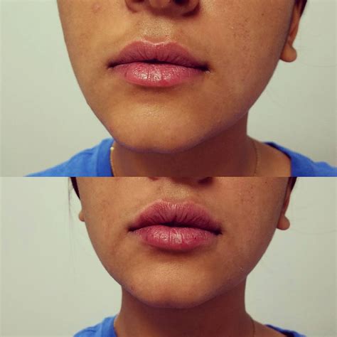 Lip Augmentation post injection - After care
