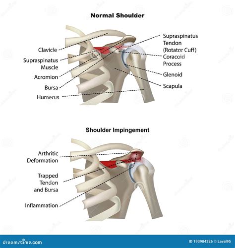 Shoulder Impingement Syndrome. Painful Abduction Stock Photography | CartoonDealer.com #127459328