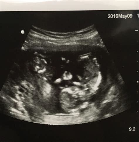 Twins Ultrasound 16 Weeks