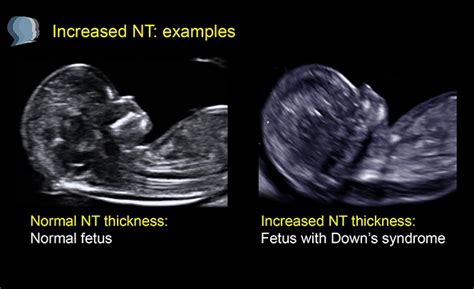 Raised NT Scan | LFMC