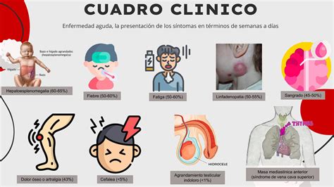 Sintomas De Leucemia Linfoblastica Aguda Leucemia Linfoblástica