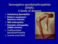 Image result for Negative Spondyloarthropathy