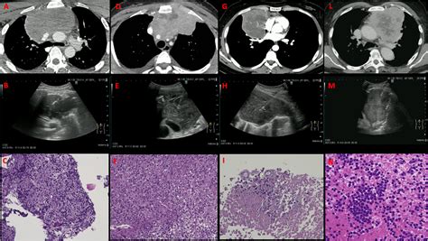 Ultrasound-guided needle aspiration biopsy of isolated anterior mediastinal masses | Pulmonology