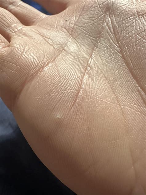 Image result for Splinter in Hand