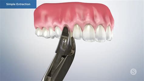 Surgical Extraction 12 的图像结果