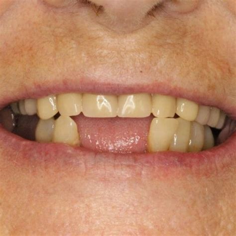 Image result for Bottom Front Teeth Partials