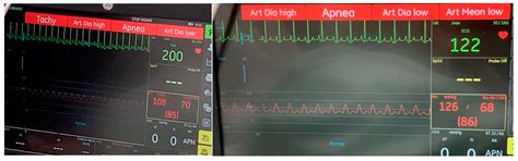 Sinus Tachycardia Following Administration of Naloxone in a Dog During ...