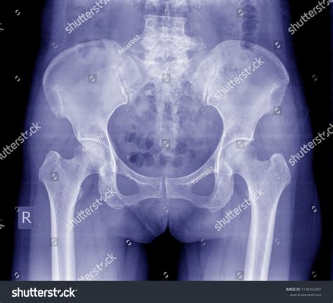 Young Female Pelvis X Ray Normal