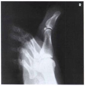 Image result for Toe Lateral View