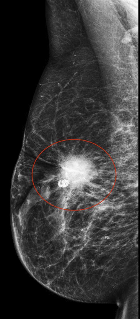 Imaging evaluation of nipple discharge: Review of literature and ...