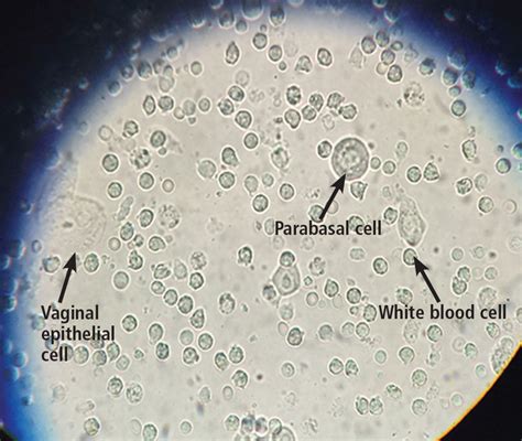 Candida Vaginitis Wet Mount
