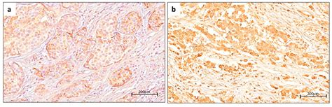 Clinical Significance of Nuclear Yin-Yang Overexpression Evaluated by ...