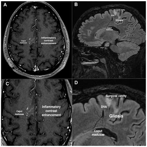 Distant Recurrence of a Cerebral Cavernous Malformation in the Vicinity of a Developmental ...